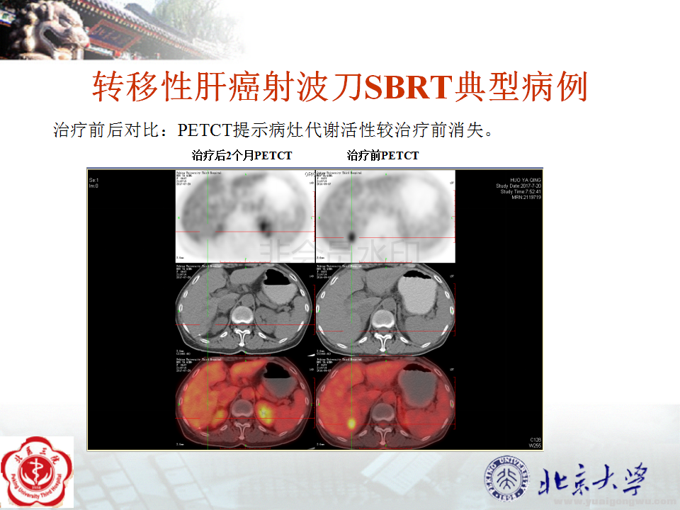 转移性肝癌典型病例_03.png