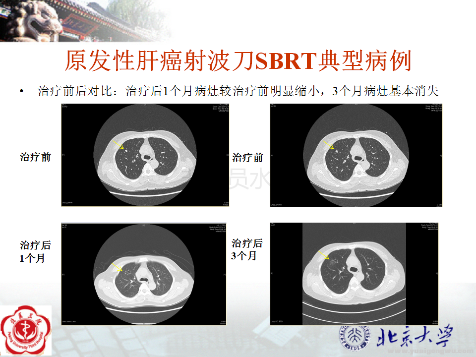 肺转移癌射波刀SBRT典型病例_02.png